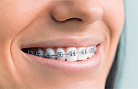 Metal Braces