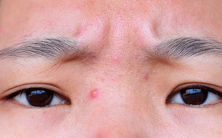 Acne and Pimples in Teenagers: Treatment