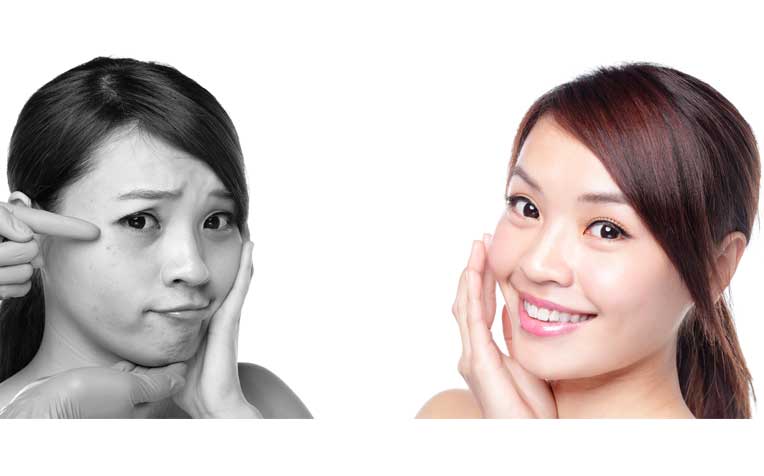 Double eyelid surgery shop sg