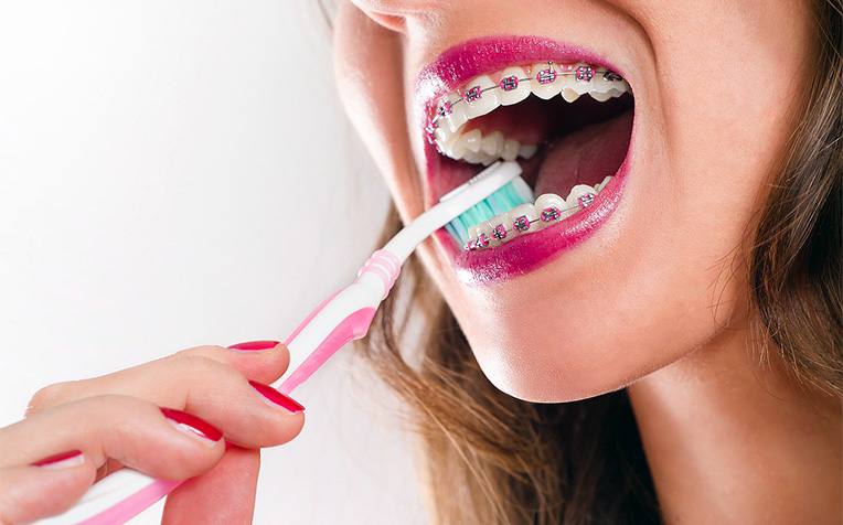  ​Braces How to Take Care 