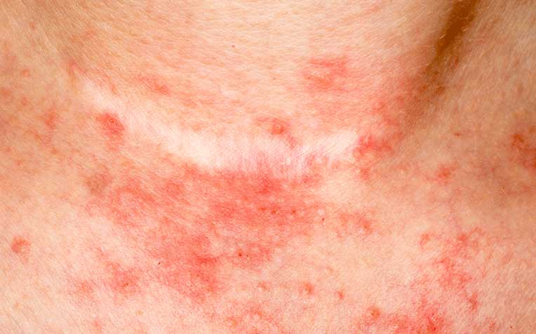 Eczema Flares: How to Prevent