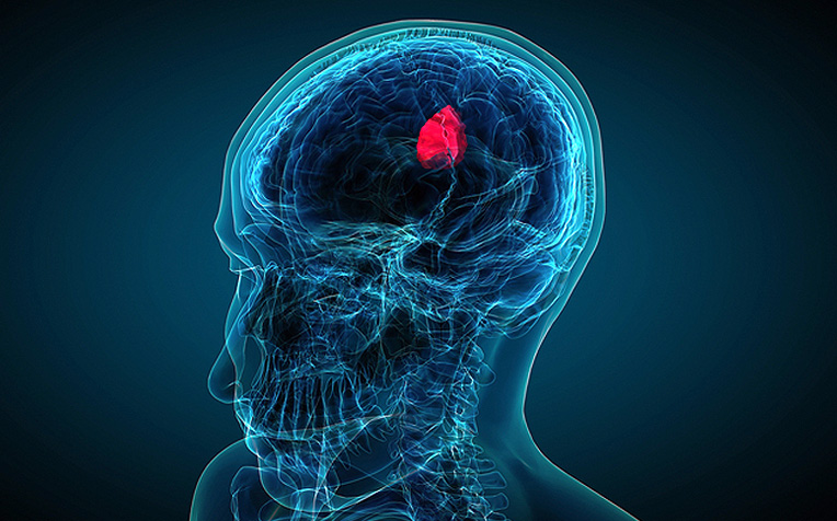 /sites/hexassets/Assets/head-neck/five-facts-about-brain-tumours.jpg