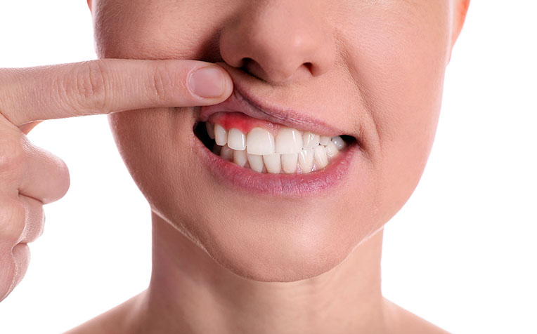 How to Prevent Gingivitis and Periodontitis Gum Disease