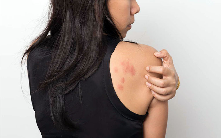 ​How To Prevent Hives (Urticaria) and Angioedema