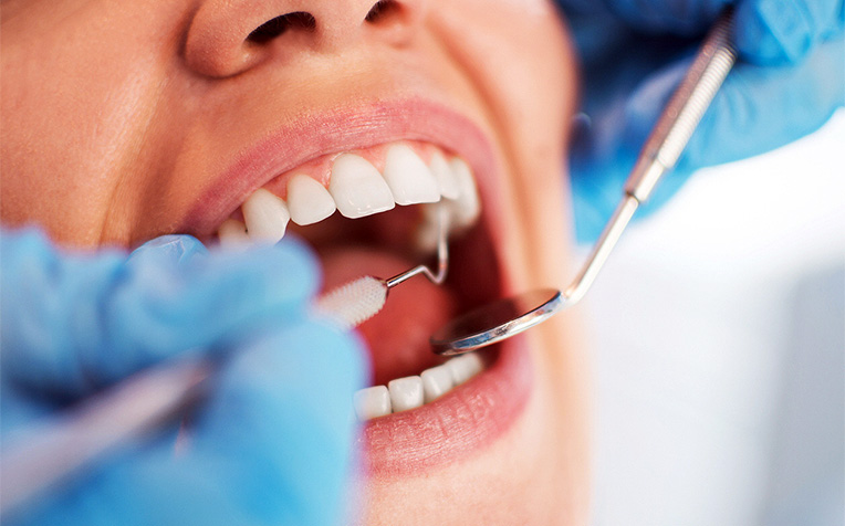  ​Gingivitis (Mild Gum Disease) Management 