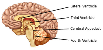 fluid on the brain