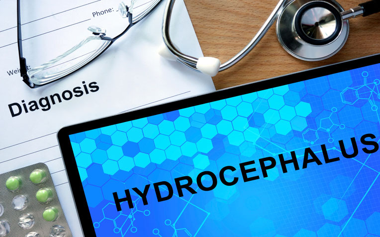 Hydrocephalus: An Excess of Cerebrospinal Fluid in the Brain
