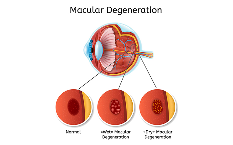 Macular Degeneration (Age Related Macular Degeneration): How to Treat