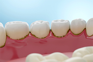 Plaque buildup on teeth and gums