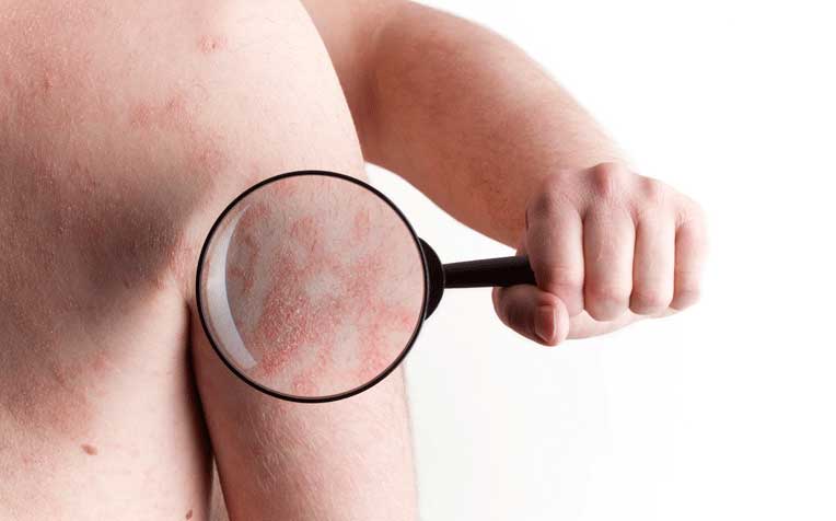 Psoriasis: Causes