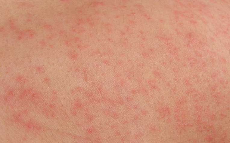 /sites/hexassets/Assets/head-neck/stevens-johnson-syndrome-treatment-and-care-tips.jpg