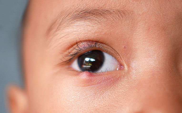  ​Stye and Chalazion What To Do 