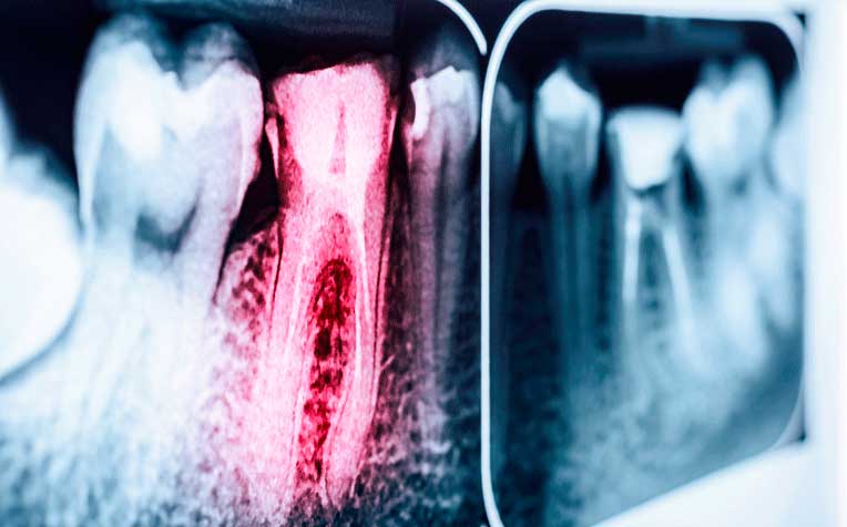 ​​​​​​​Tooth Decay: How a Root Canal Helps
