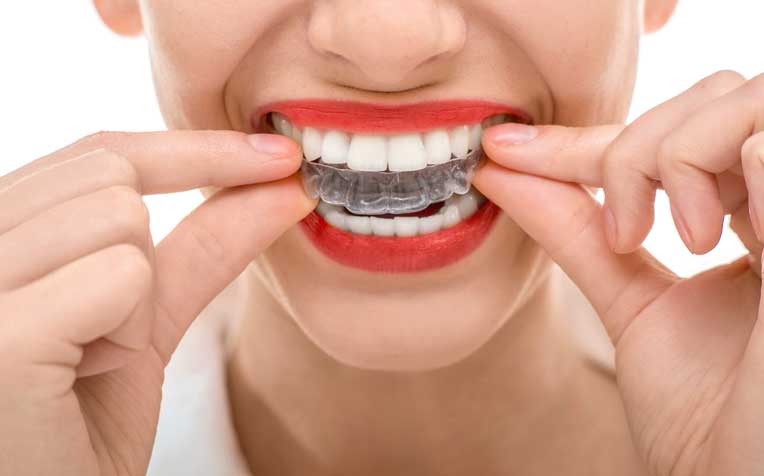  ​What Are Some Braces Options for Adults?