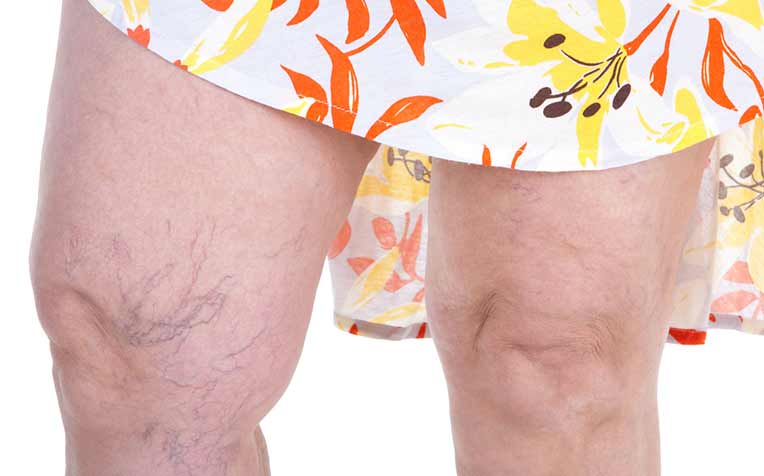 /sites/hexassets/Assets/head-neck/venous-insufficiency-manifests-as-varicose-veins.jpg
