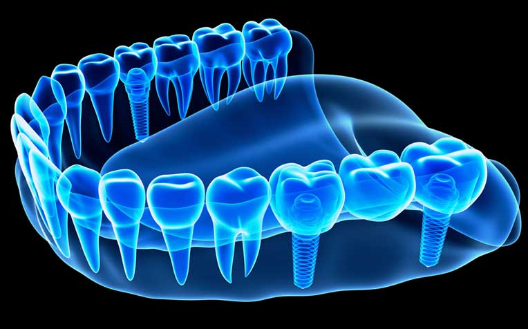 /sites/hexassets/Assets/head-neck/why-are-dental-implants-increasingly-popular-in-singapore.jpg