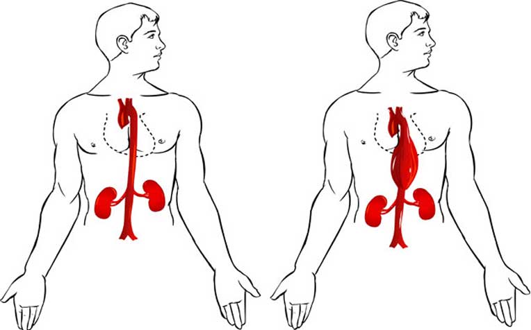 Aortic Aneurysm: Symptoms and Causes