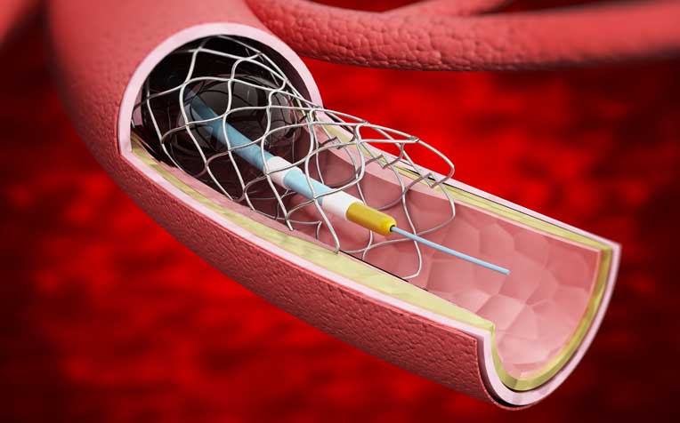 Aortic Dissection: Diagnosis and Treatment