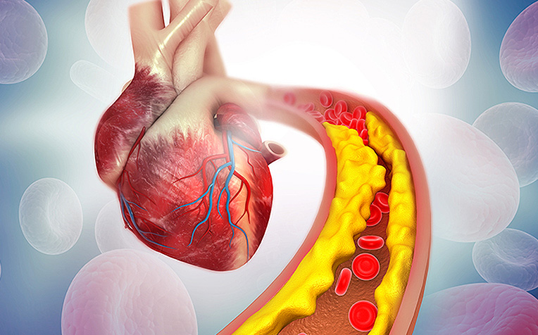 Atherosclerosis (Plaque Buildup) : How It Can Lead to a Heart Attack -  HealthXchange