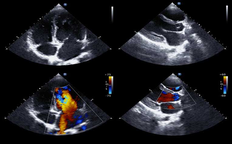 Cardiac Tests: Stress Echocardiogram and Nuclear Cardiology Test 