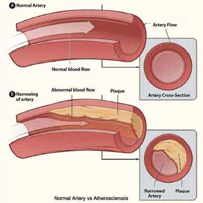 Coronary Artery Disease