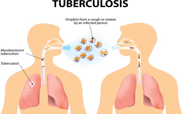 Tuberculosis (TB): Types, Symptoms, and Risks