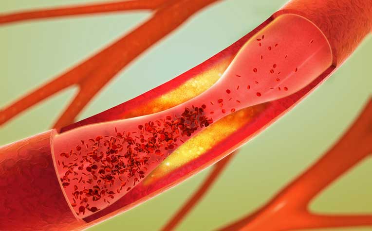 What Is Coronary Artery Disease (CAD)?  