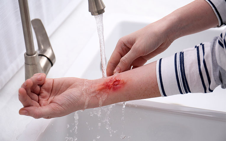 Boiling water burn (scald): Symptoms, treatments, and home remedies