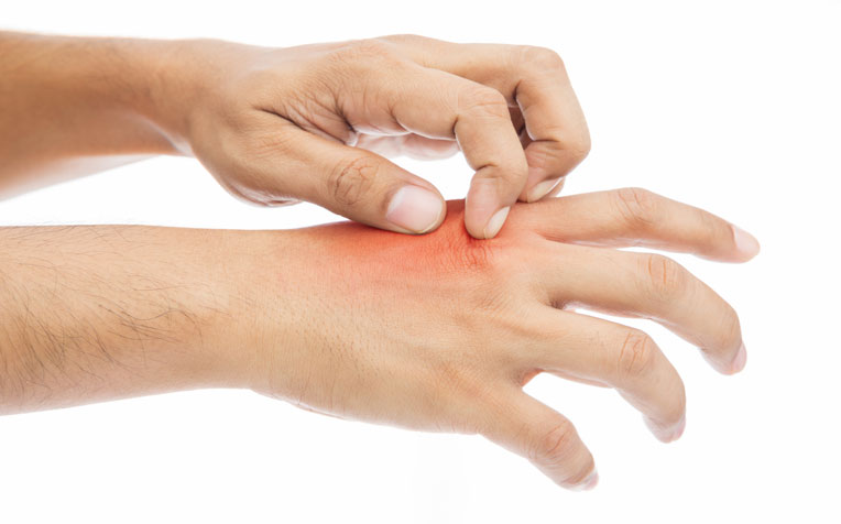​Burn Injuries: Treatment and Tips