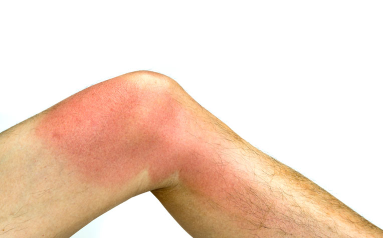 ​Burn Injuries: Types and Symptoms