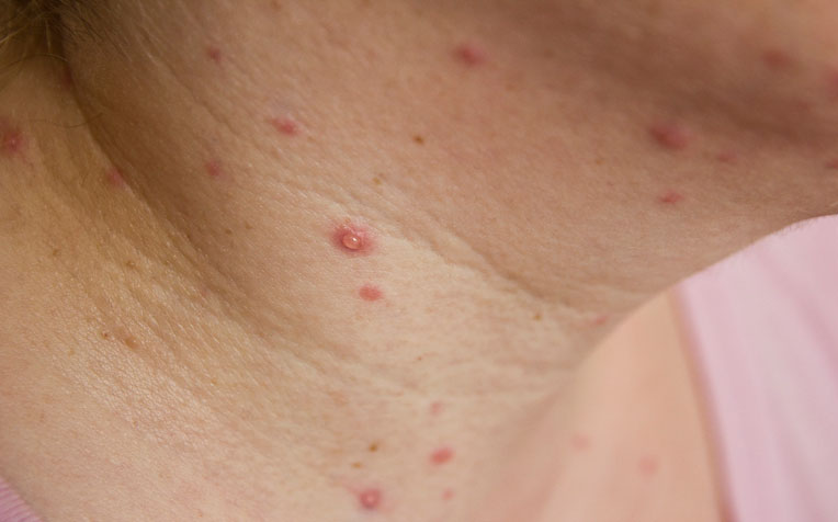 Chicken Pox In Adults Pregnant Women And Shingles