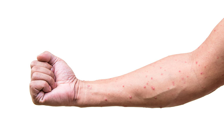  ​Chicken Pox In Adults Symptoms and Complications