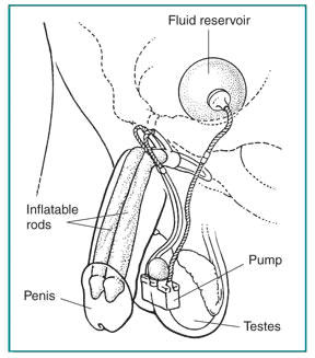 Penile implant