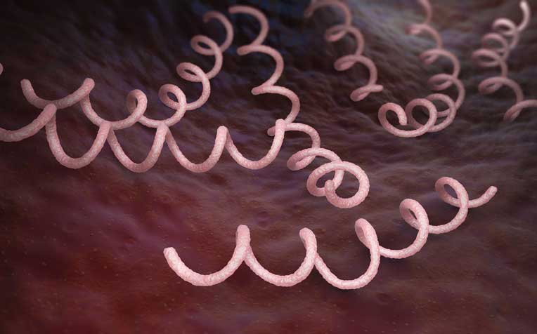 ​Syphilis: Signs, Complications and Treatment