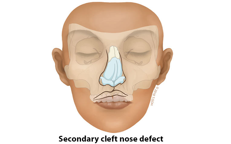 Secondary cleft nose defect