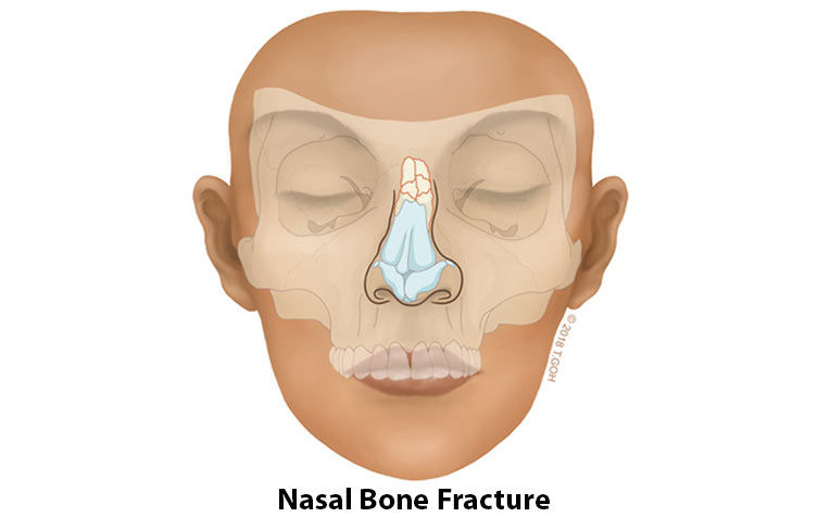 Nasal Bone Fracture Radiology