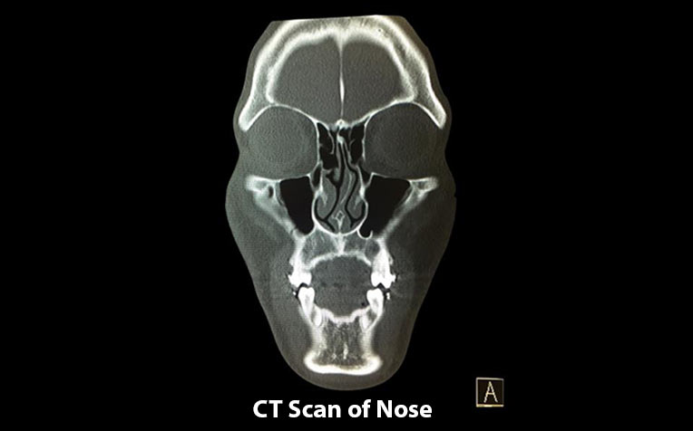 CT scan of nose