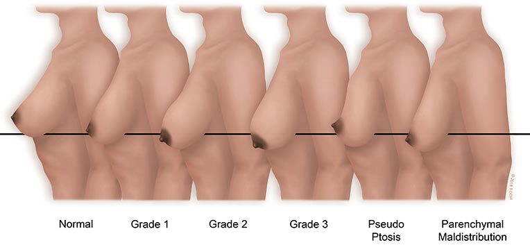 Breast Ptosis