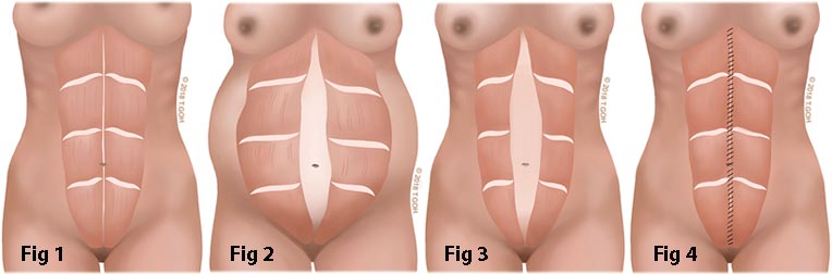 Rectus divarication pre and post-pregnancy