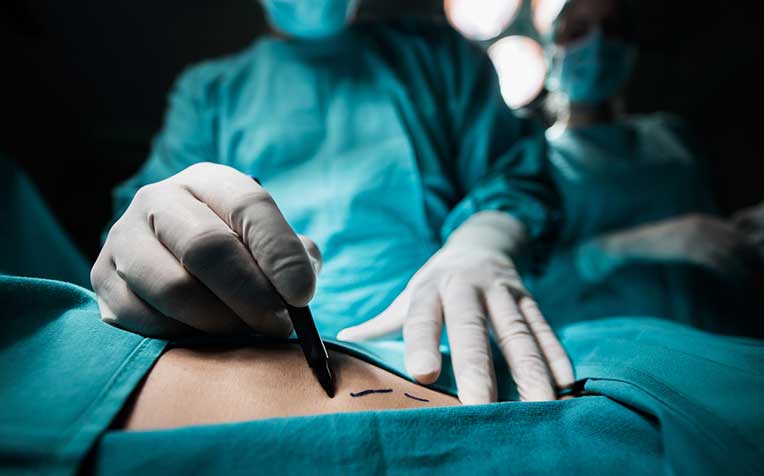 Body Contouring Surgery: What You Need to Know - HealthXchange