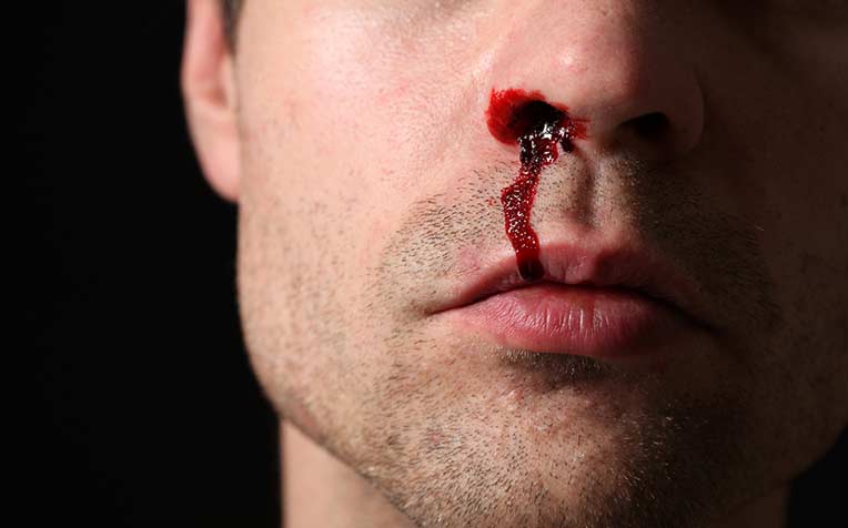 ​Broken Nose: How to Stop the Bleeding and What to Do Next