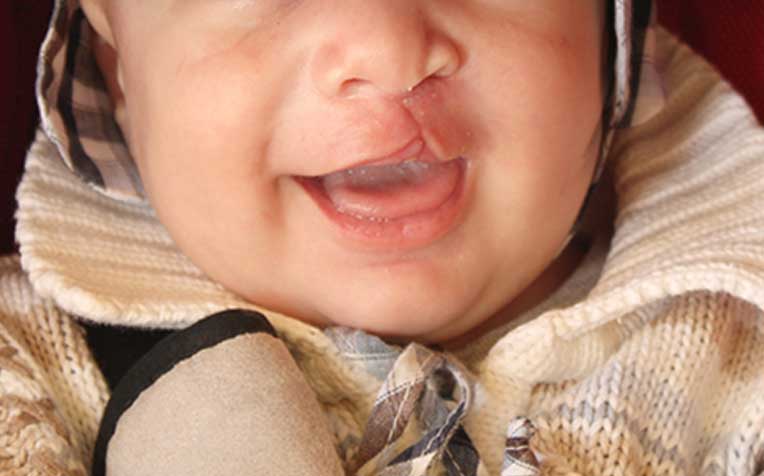 Cleft rhinoplasty is a reconstructive procedure to correct cleft lip and nose deformities.