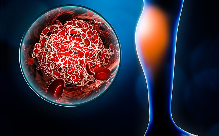 Deep Vein Thrombosis (DVT): How to Prevent and Manage