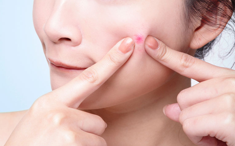 Stretch Marks, Acne and Other Skin Changes During Pregnancy