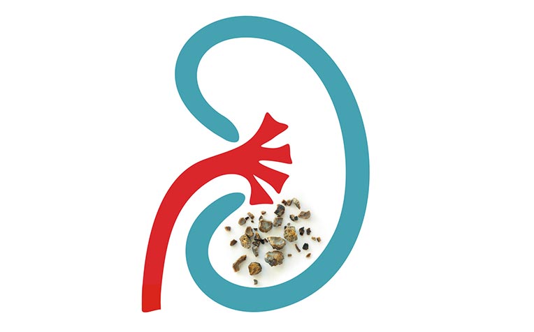  Kidney Stones (Urinary Stones) FAQs Answered! 