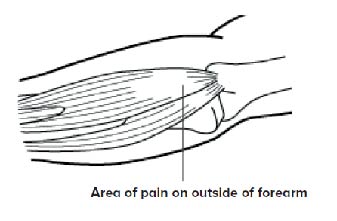Tennis Elbow - SingHealth Duke-NUS Sport & Exercise Medicine