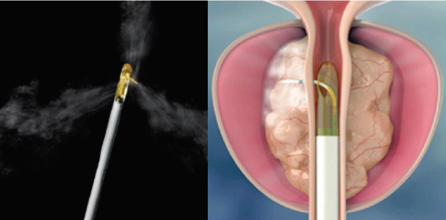 Delivery of targeted convective water vapour energy to the region of the prostate gland causing the obstruction