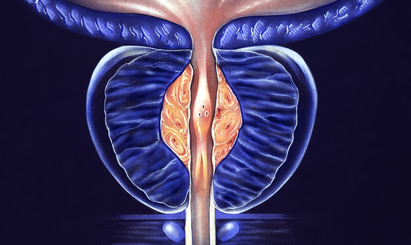 ​Rezum: A Minimally Invasive Option for Benign Prostatic Hyperplasia - Changi General Hospital