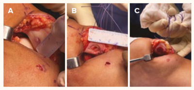  The surgical procedure of AMIC - SingHealth Duke-NUS Cell Therapy Centre