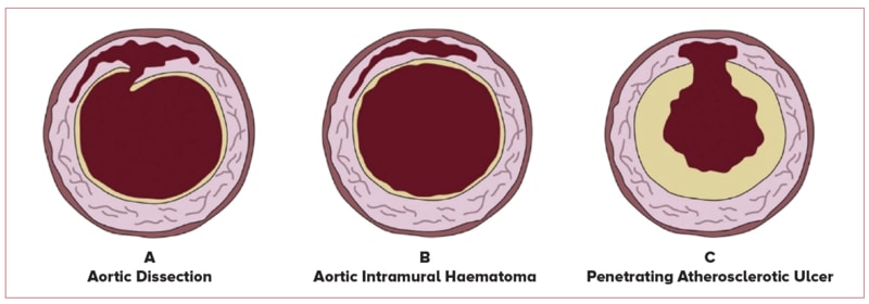 Acute aortic syndrome - SingHealth Duke-NUS Vascular Centre
